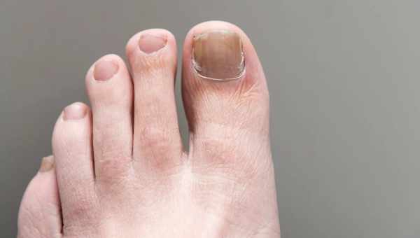 Как лечить грибок ногтейГрибок ногтей (онихомикоз) является инфекционным заболеванием, которое поражает ногтевые пластинки. Данное заболевание свойственно не только для женщин, но и для сильной половины человечества. При этом мужчины чаще страдают грибком