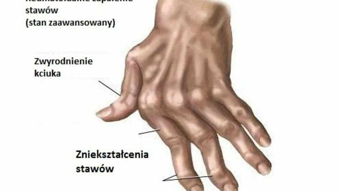 Артрит пальцев рук Стадии артрита