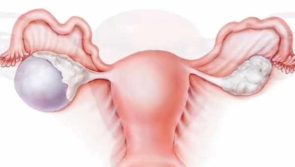 Киста яичника. 6 ранних симптомов, которые нельзя игнорировать!
