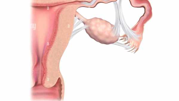Как определить и вылечить сальпингоофорит