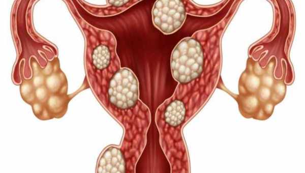 Миома матки при беременности